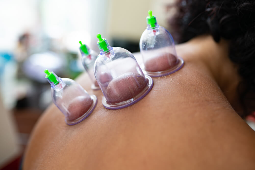 upper-back-cupping-therapy upper-back-cupping-therapy