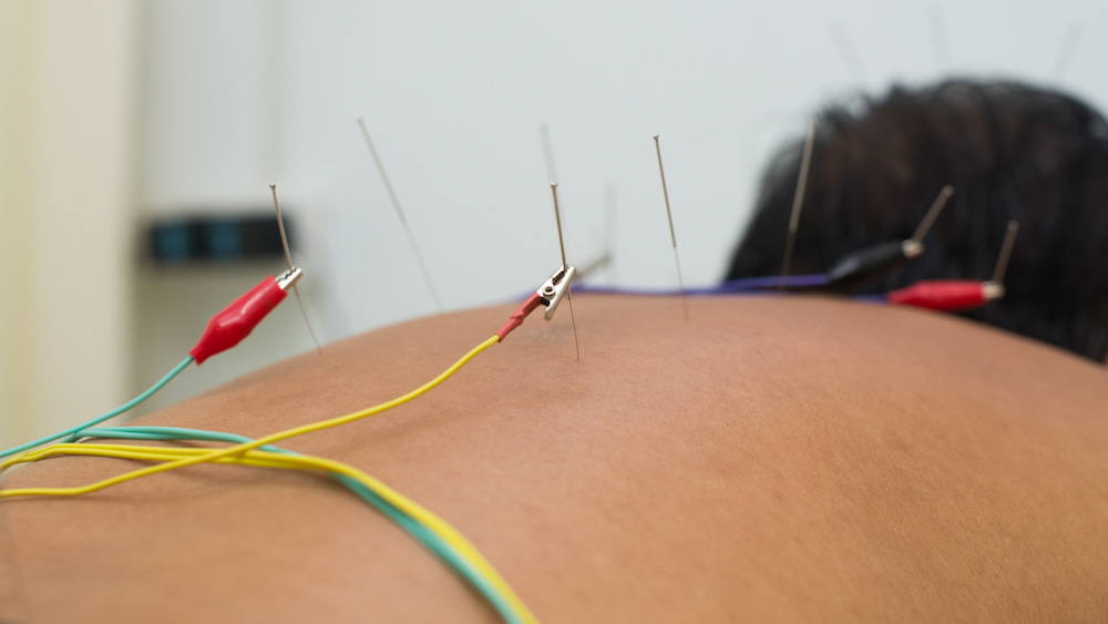 Dry-Needling